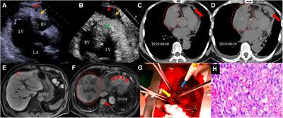 Case report: Primary pericardial angiosarcoma, a rare cause of cardiac tamponade